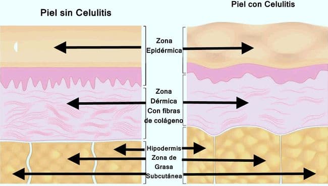 piel con celulitis